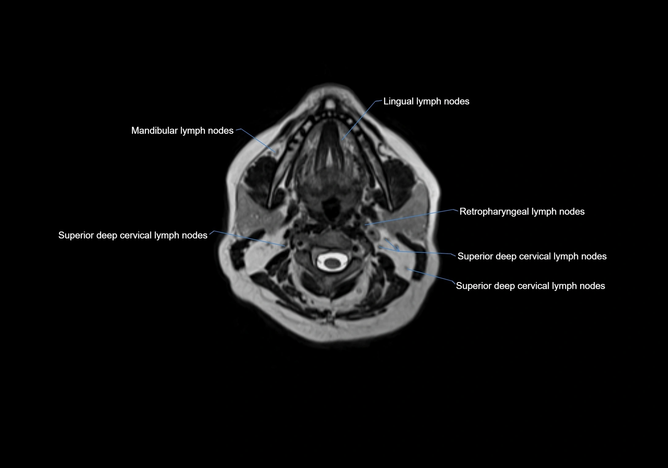 Neck axial  lymph node cross sectional MRI anatomy 3T MRI  image-img-00001-00043.webp